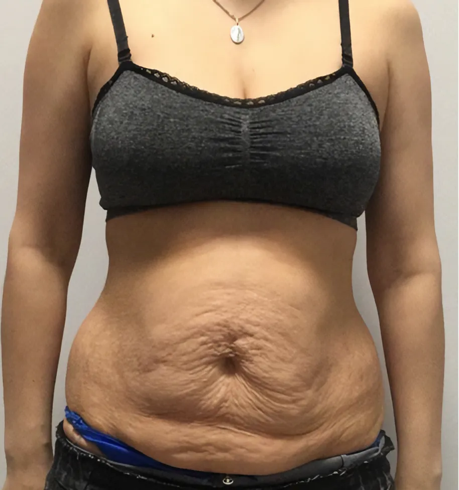 Abdomen with loose skin before treatment