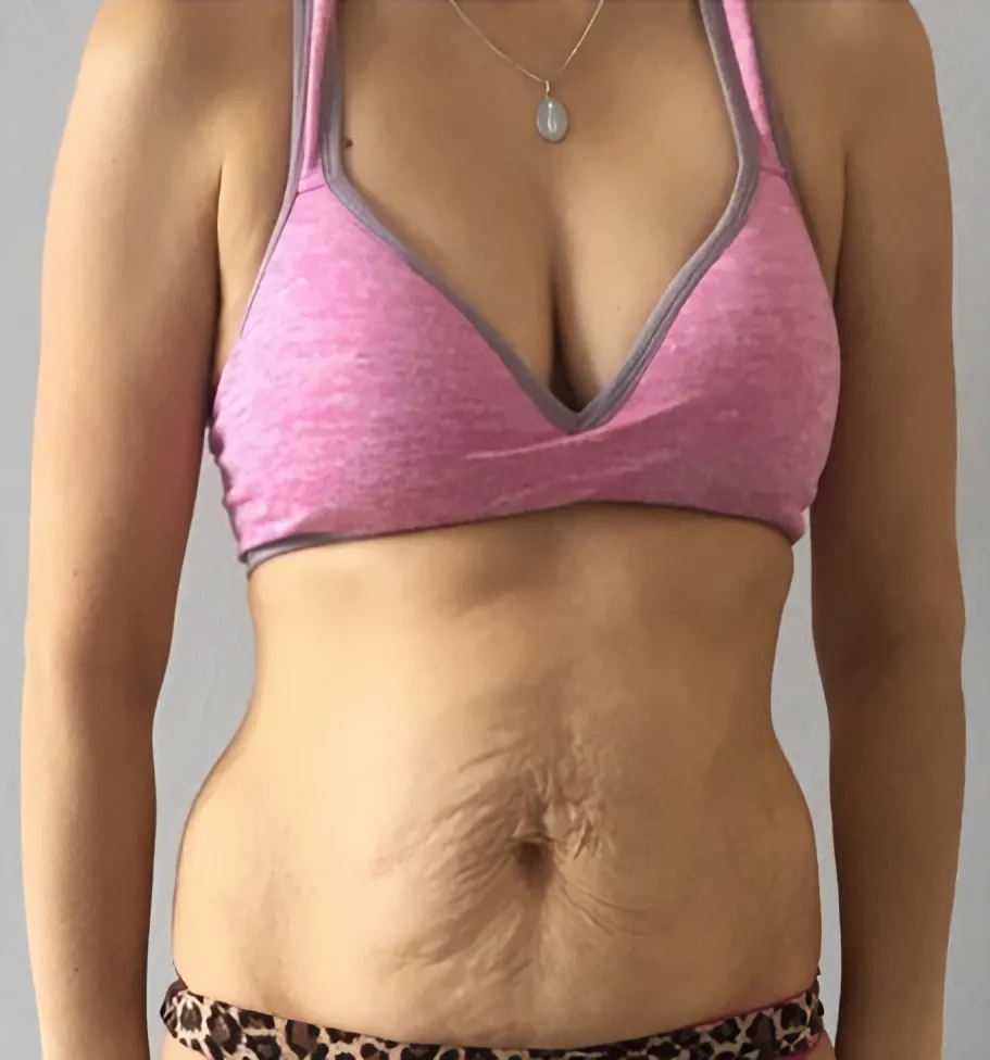 Abdomen with stretched loose skin before treatment