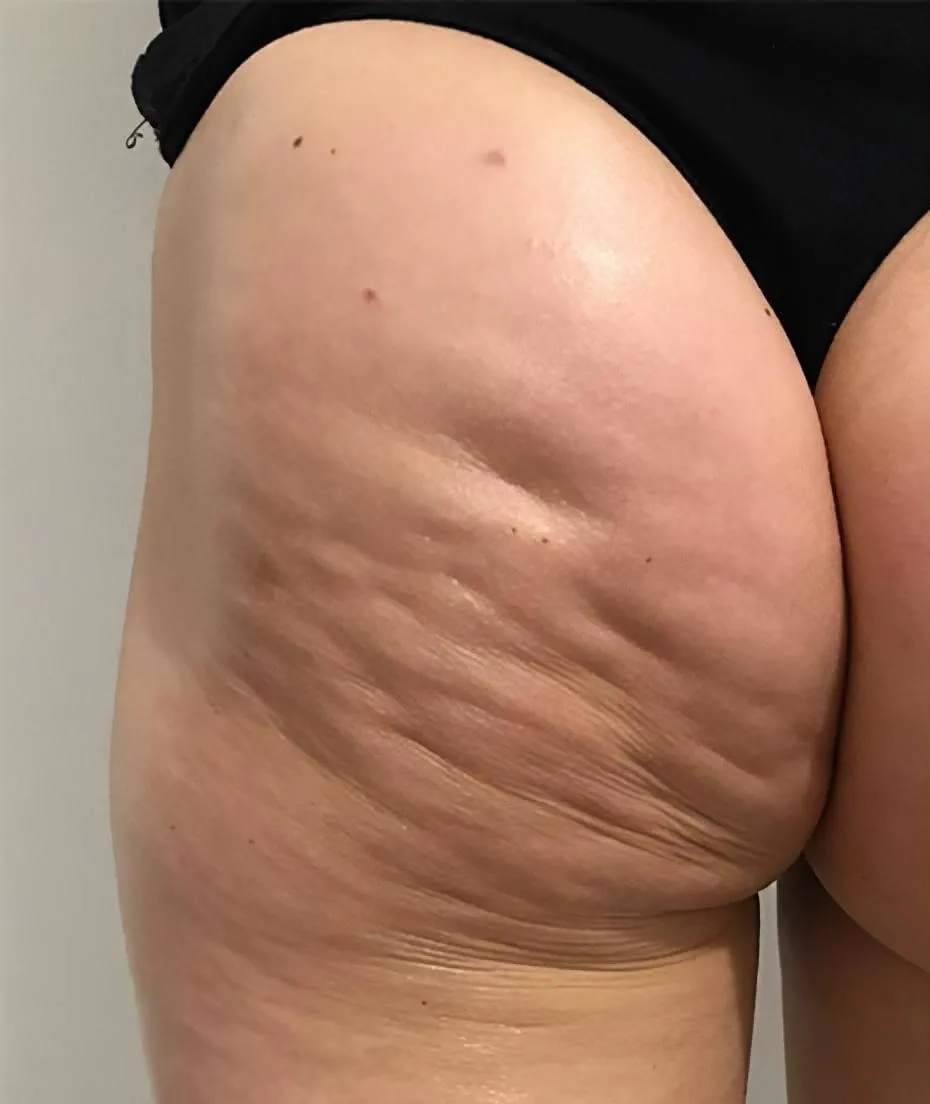 Buttocks with cellulite, side-back view