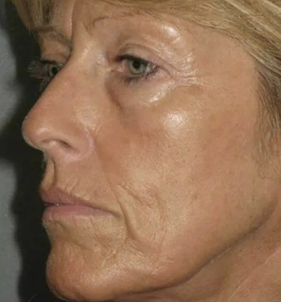 Mature face in profile with deep wrinkles