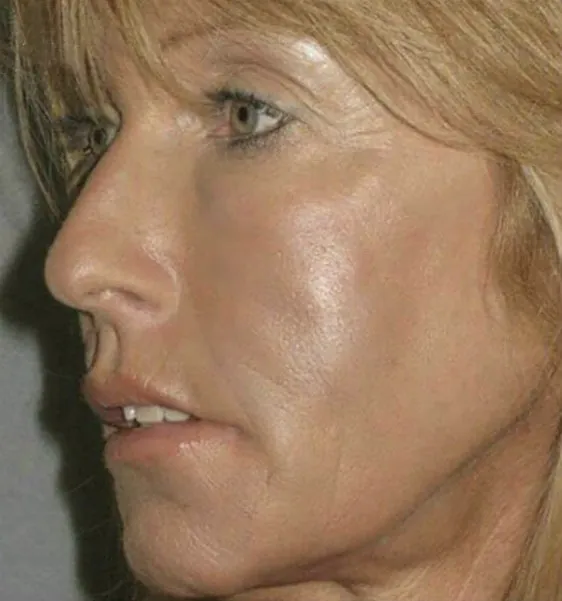 Face in profile with mature skin before rejuvenation