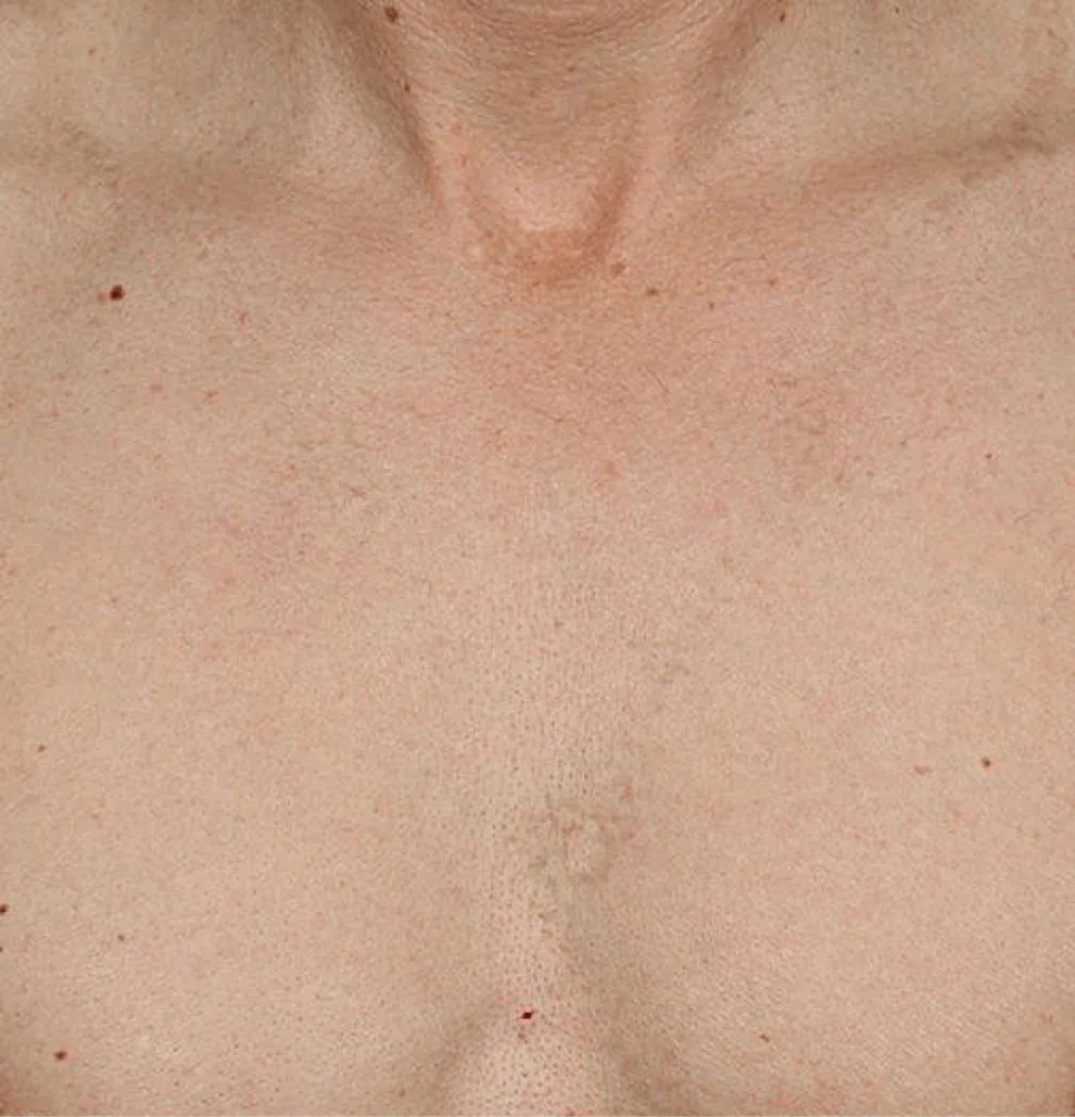 Clear skin of the chest after tattoo removal