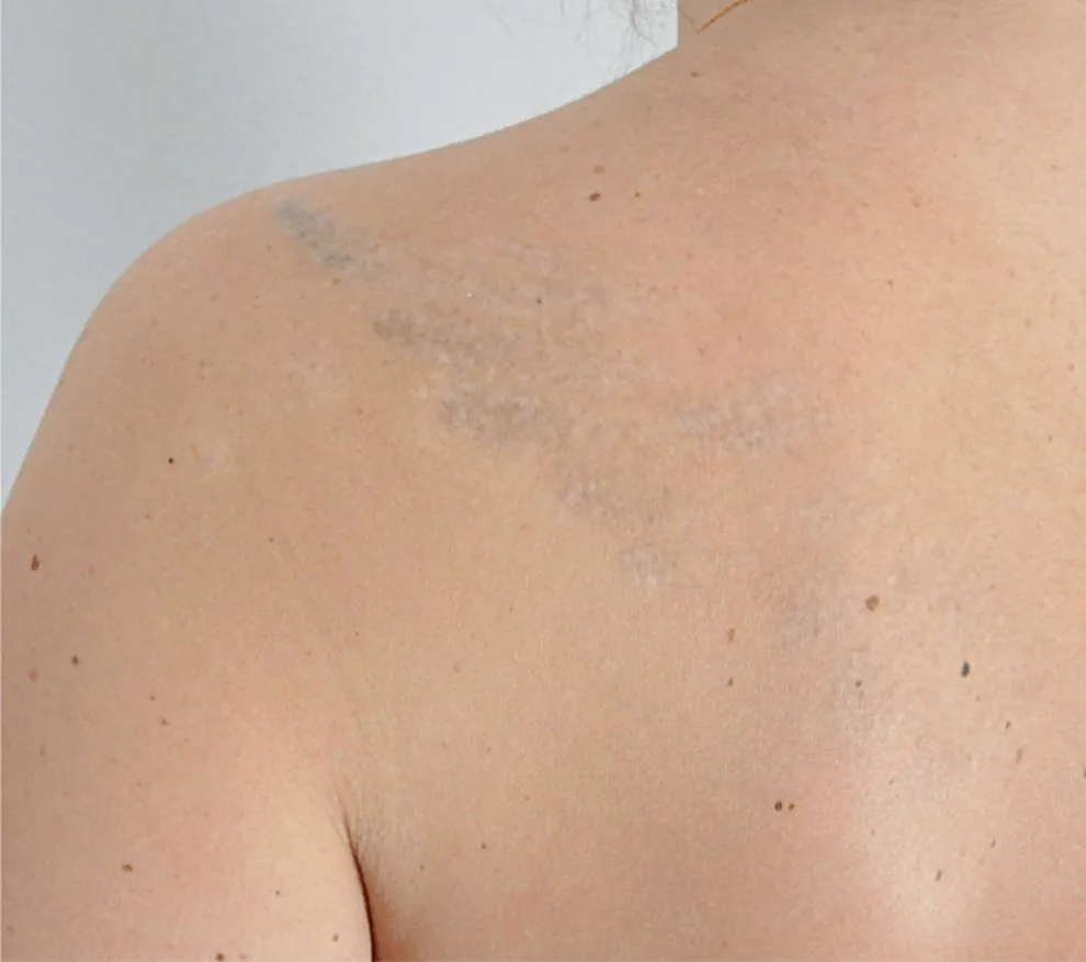 Shoulder skin with a faded tattoo after laser treatment