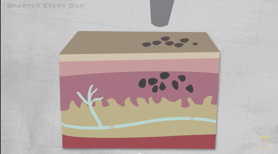 Animation: a laser beam breaking up pigment in the layers of the skin