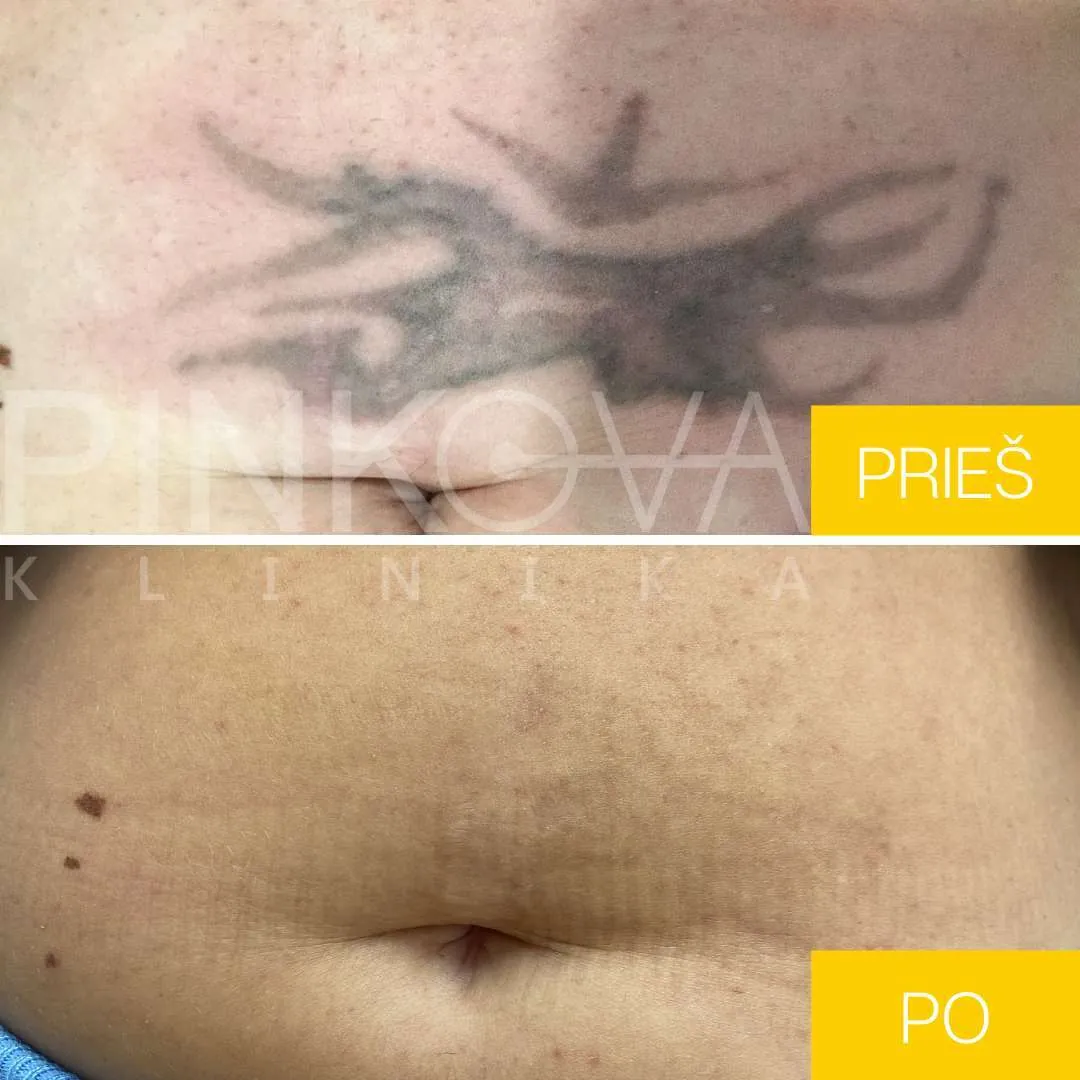Before and after laser removal of a tattoo on the abdomen